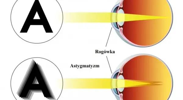 Astygmatyzm: Jak skutecznie korygować i trwale usunąć wadę?