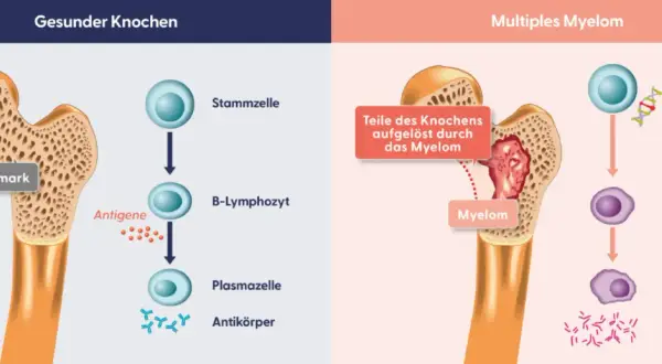 Erster Schritt der Therapie: gesunder Knochen vs. multiples Myelom. Myelomzellen schädigen Knochen und produzieren fehlerhafte Antikörper.