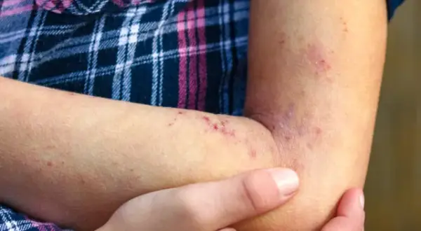 Czy cukinia uczula? Objawy alergii, które warto znać