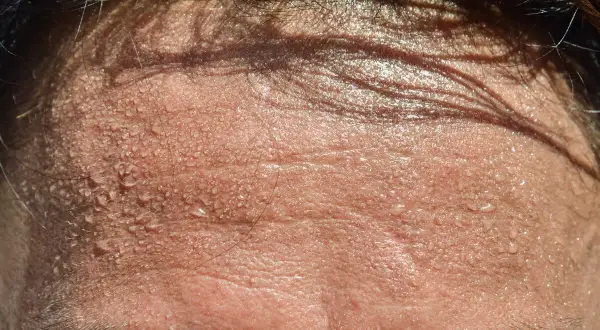Frente sudorosa, con gotas de agua brillando. Busca trucos para no sudar por la cabeza y mantenerte fresco.