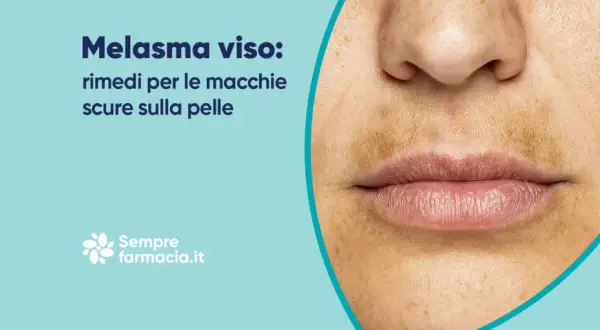 Primo piano del viso con melasma, evidenziando le macchie scure sulla pelle.