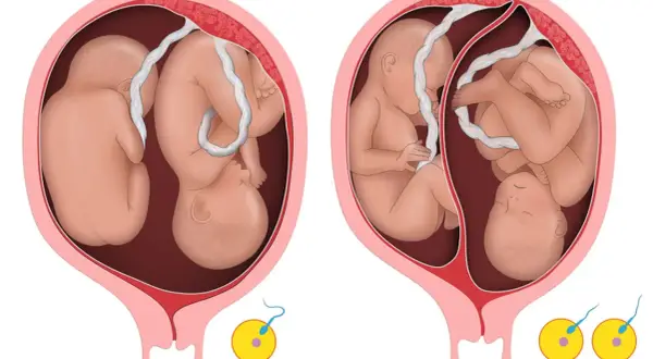 Dwa płody w macicy, ilustracja pokazująca niezauważona ciąża mnoga. Dwa zarodki z plemnikami poniżej.