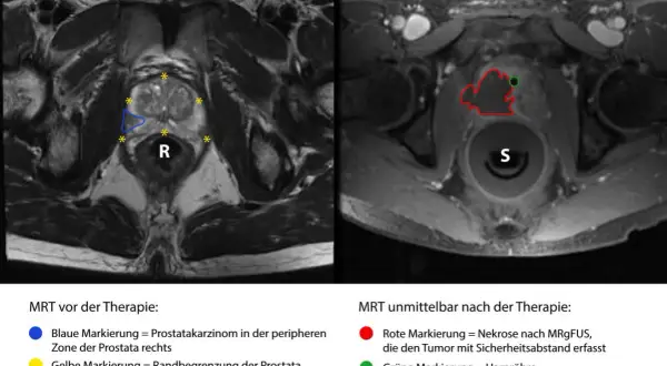 MRT-Aufnahmen zeigen metastasierten Prostatakrebs vor und nach Therapie. Links: Prostatakarzinom (blau) und Prostata-Rand (gelb). Rechts: Nekrose (rot) nach MRgFUS.