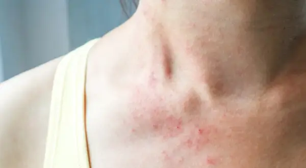 Skóra na szyi i dekolcie jest zaczerwieniona i podrażniona. Może to być objaw alergii lub innej choroby skóry, którą leczy się np. **locoid lipocream**.