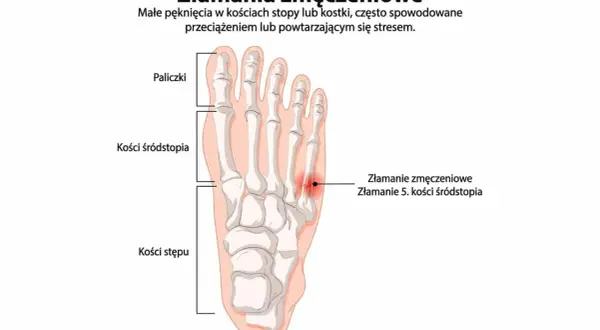 Anatomia stopy z zaznaczonym złamaniem zmęczeniowym 5. kości śródstopia.