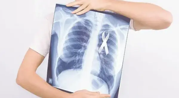 Rentgen klatki piersiowej z białą wstążką symbolizującą nadzieję na leczenie, np. pembrolizumabem.