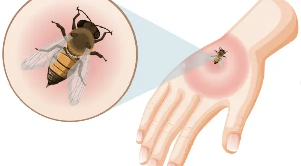 Nahaufnahme einer Biene auf einer Hand, die eine Rötung zeigt. Dies illustriert die Reaktion auf einen Wespenstich, der eine Allergie auslösen kann.