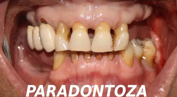 Zaawansowana paradontoza z widocznymi ubytkami kości i zębów. Rozważenie implantów jako rozwiązania problemu.