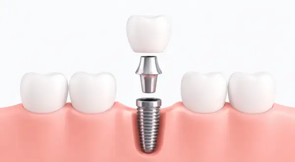 Componentes de un implante dental: tornillo, pilar y corona, listos para ser ensamblados en la encía.