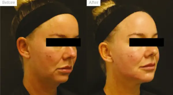 Modelowanie żuchwy przed i po zabiegu. Widoczna poprawa konturu twarzy i linii żuchwy.