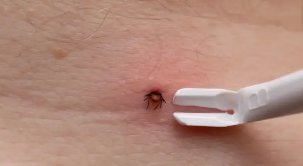 Kleszcz wbity w skórę, obok specjalne szczypce do jego usuwania. Czy kleszcz może wejść pod skórę? Nie, ale wgryza się głęboko.