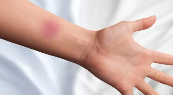 Ein blauer Fleck am Unterarm, der mit Arnika gegen blaue Flecken behandelt wird.