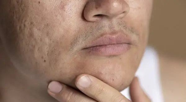 Primer plano de un rostro masculino con marcas de acné visibles en la mejilla y la barbilla.