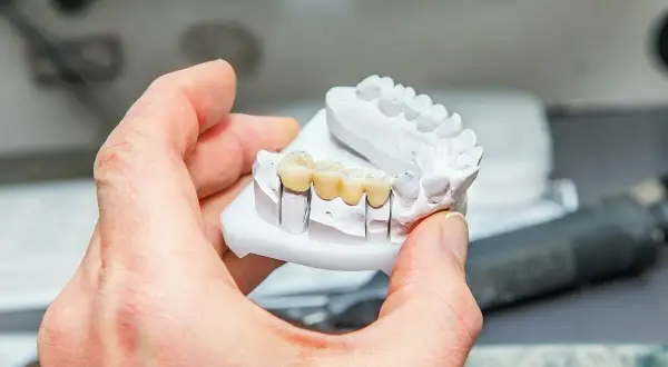 Model szczęki z widocznym, wykonanym z porcelany mostkiem na zębach.