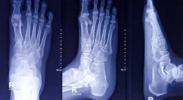 Radiografie del piede destro mostrano una frattura non consolidata con sintomi evidenti.