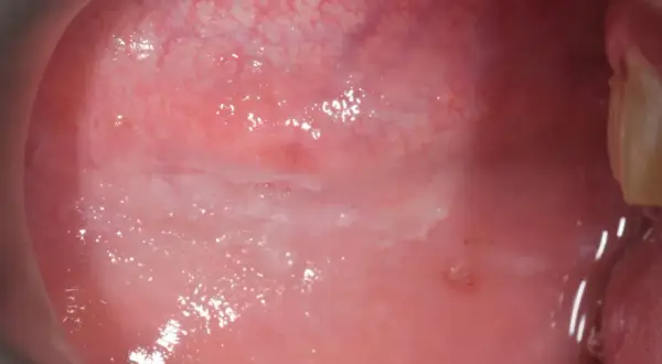 Mucosa orale con aree biancastre e arrossate, indicative di morsicatio buccarum, un'abitudine di mordicchiarsi le guance.