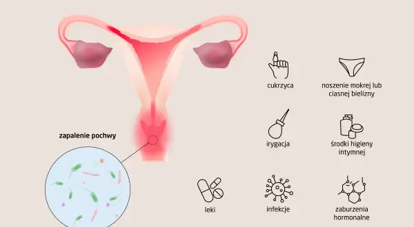 Ilustracja przedstawia przyczyny zapalenia pochwy: cukrzyca, mokra bielizna, irygacja, leki, infekcje, zaburzenia hormonalne.