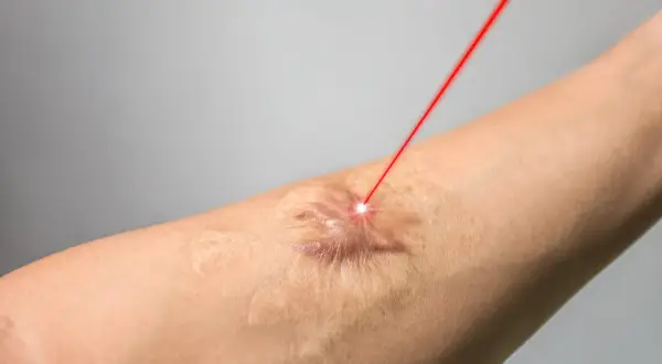Czerwony promień lasera skierowany na bliznę na skórze ramienia, symbolizujący nowoczesne leczenie blizn.