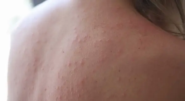 När barn får soleksem kan det se ut så här på ryggen, med små röda prickar och utslag.