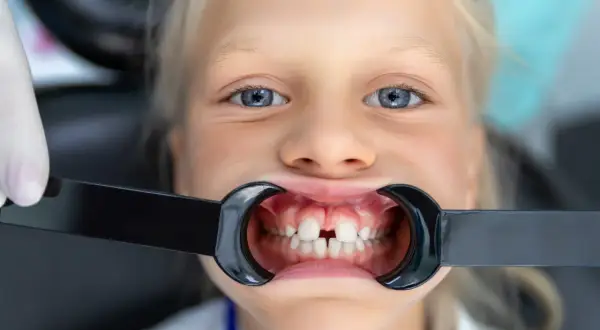 Uśmiechnięta dziewczynka z niebieskimi oczami, u której widoczna jest diastema u dzieci. W ustach ma rozwierak dentystyczny.