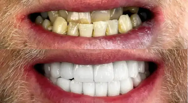 Ile licówek potrzebujesz? Od 1 zęba po Hollywood Smile!