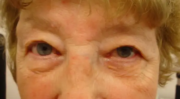 Nahaufnahme eines Gesichts mit Falten um die Augen. Ein gelblicher Fleck ist am rechten Unterlid sichtbar, ein mögliches Symptom eines Aderhautmelanoms.