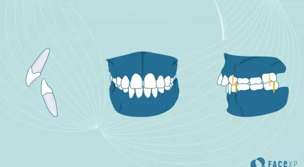 Illustrazione di denti sporgenti, prima e dopo il trattamento ortodontico.