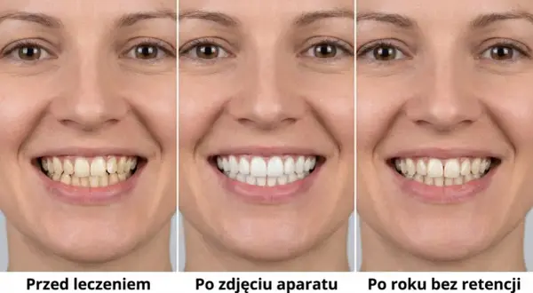 Uśmiech przed leczeniem, po zdjęciu aparatu stałego i po roku bez retencji. Widać znaczącą poprawę.