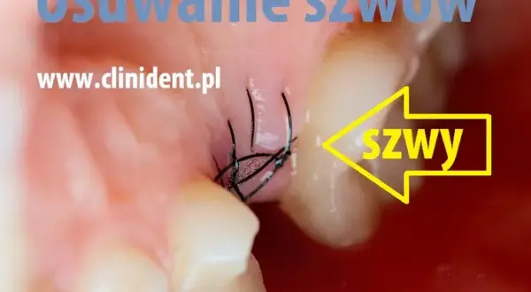Zdjęcie szwów u dentysty: Koszt, NFZ i jak zaoszczędzić?