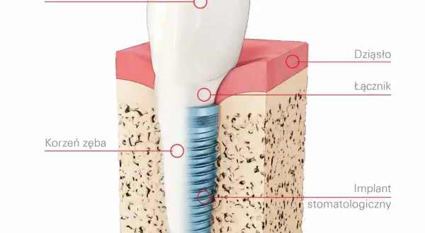 Co to jest implant zęba? Wszystko, co musisz wiedzieć o korzyściach i procesie implantacji