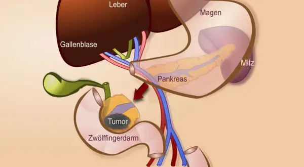 Anatomische Darstellung des Pankreas, Zwölffingerdarms und der Gallenblase mit einem Tumor. Zeigt den Bereich für eine partielle duodenopankreatektomie.