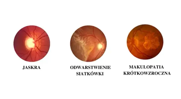 Trzy obrazy dna oka: jaskra, odwarstwienie siatkówki i makulopatia krótkowzroczna, pokazujące różne problemy wpływające na ostrość wzroku.