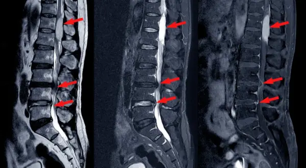 Obraz MRI kręgosłupa lędźwiowego z widocznymi zwężeniami kanału kręgowego (stenoza kanału kręgowego) zaznaczonymi czerwonymi strzałkami.