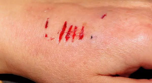 Krwawiące zadrapania na dłoni, przypominające ślady po ugryzieniu przez psa. Zastanawiasz się, jak długo goi się rana po ugryzieniu przez psa?