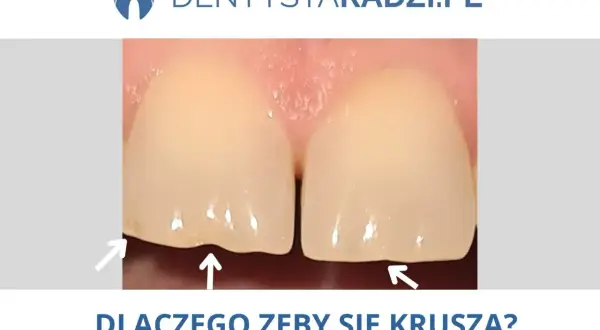 Zbliżenie na dwa zęby z widocznymi ubytkami na krawędziach, wskazującymi na ukruszone szkliwo. Strzałki podkreślają problem.