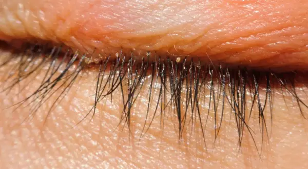 Nahaufnahme des menschlichen Augenlids mit Wimpern. Kleine, helle Punkte, die wie Milben am Auge aussehen, sind auf den Wimpern und der Haut sichtbar.