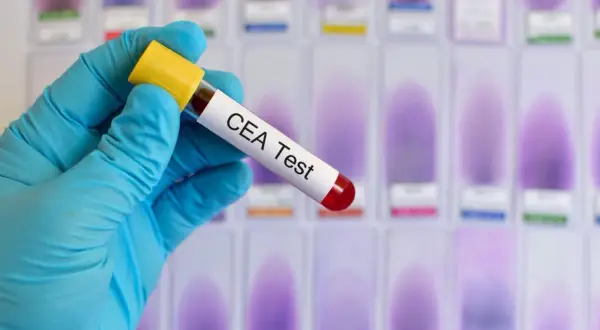 Rękawiczka trzyma probówkę z napisem "CEA Test". W tle widać rząd szkiełek mikroskopowych z fioletowymi plamami.