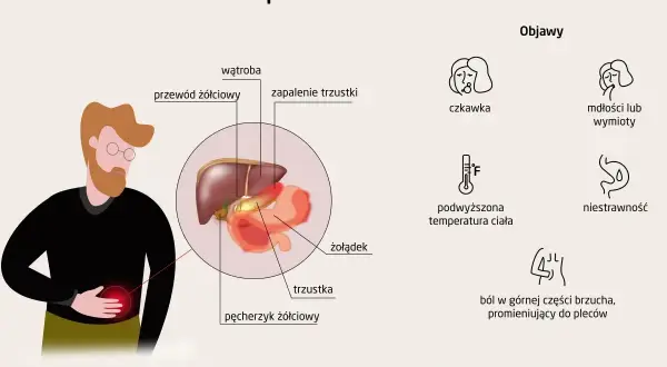 Ilustracja przedstawia objawy zapalenia trzustki: ból brzucha, nudności, gorączkę i niestrawność.