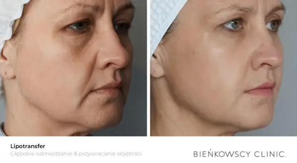 Przed i po zabiegu lipotransferu. Widoczne wygładzenie skóry i przywrócenie objętości twarzy.
