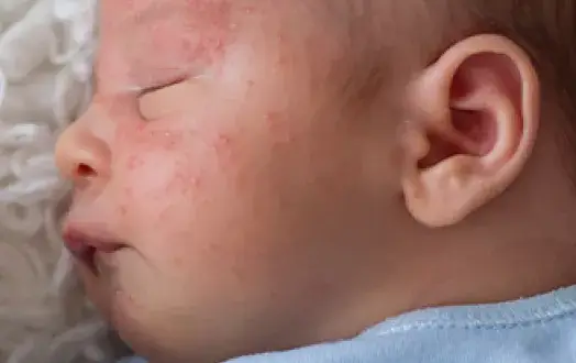 Alergia na BMK u niemowlaka: Objawy, które musisz znać!