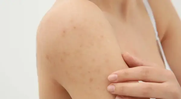 Widoczne grudki pod skórą na ramieniu, które mogą być objawem problemów dermatologicznych.