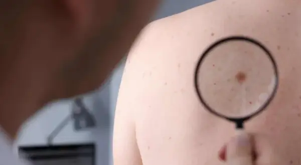 Dermatolog bada znamiona barwnikowe na plecach pacjenta za pomocą lupy.