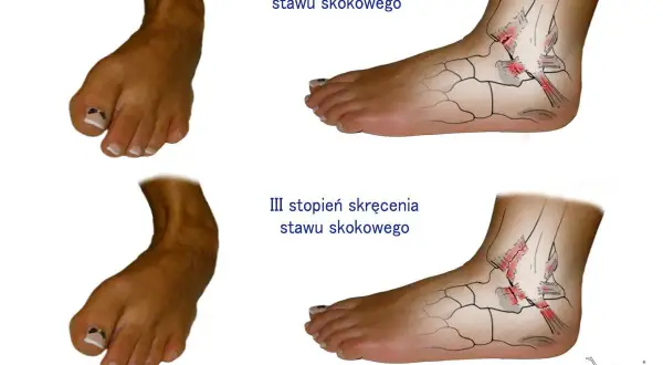 Ilustracja przedstawia stopę z zaznaczonymi uszkodzeniami więzadeł stawu skokowego w II i III stopniu skręcenia.