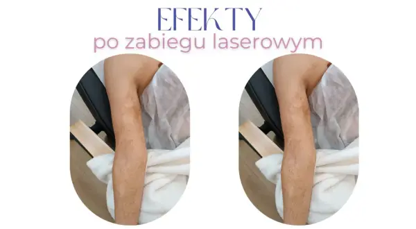 Przed i po zabiegu laserowym: widoczne ciemne blizny na nogach stają się jaśniejsze i mniej widoczne.