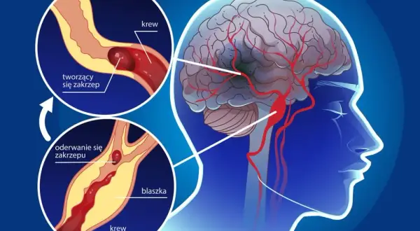 PFO objawy neurologiczne: Jak unikać ryzyka udaru mózgu?
