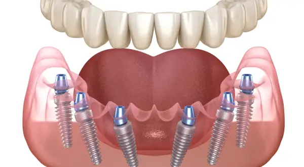 Implantes dentales all on six para una sonrisa completa y natural.