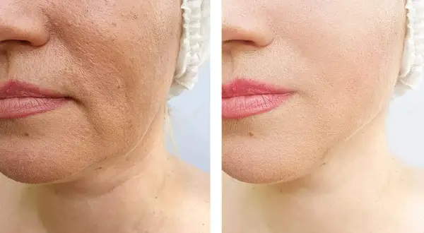 Confronto pelle: pori dilatati prima e dopo, con un visibile miglioramento della texture e della compattezza.