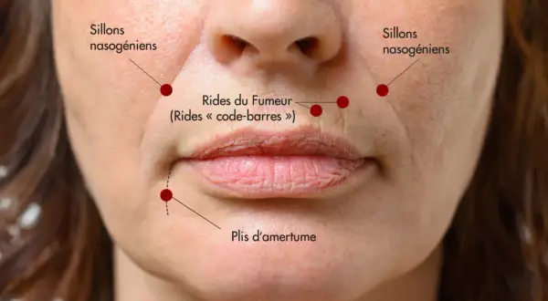 Gros plan sur le visage d'une femme, montrant les sillons nasogéniens, les rides du fumeur autour des lèvres et les plis d'amertume.