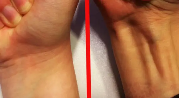 Vergleich zweier Handgelenke: Links glatt, rechts mit sichtbaren Sehnen, darunter der palmaris longus.