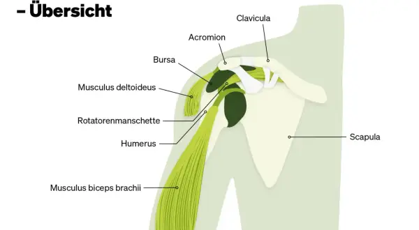Schulteranatomie: Schulterblatt (Scapula), Oberarmknochen (Humerus), Schlüsselbein (Clavicula), Acromion, Bursa, Deltamuskel (Musculus deltoideus), Bizepssehne (Musculus biceps brachii) und Rotatorenmanschette. Der Levator scapulae ist hier nicht expli...
